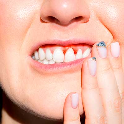 gingivitis como prevenirla