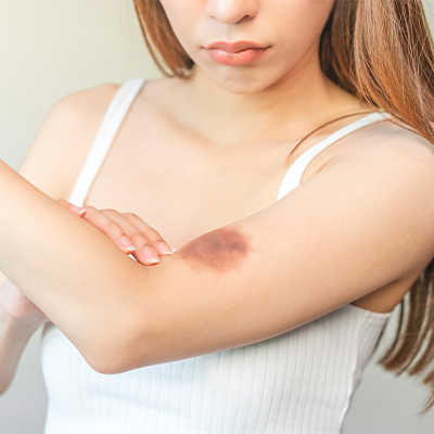 mujer con moreton en el brazo