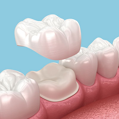 colocacion de la corona dental sobre el diente molar